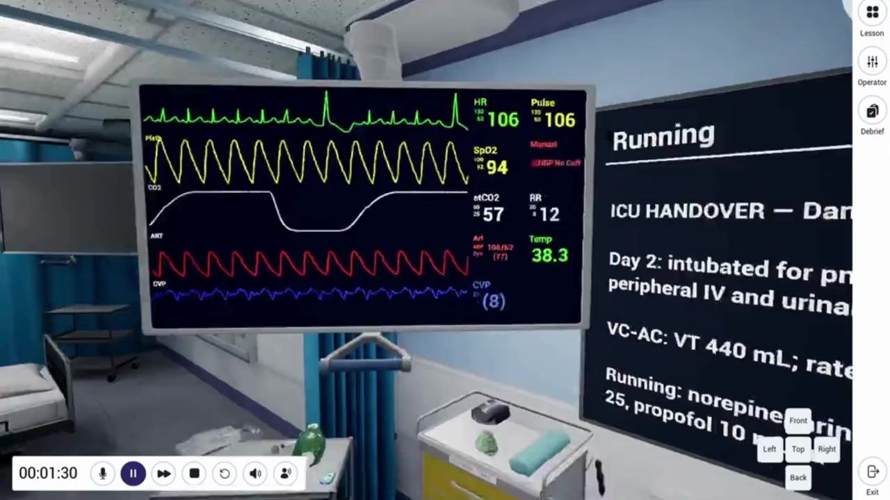 Ventilator waveforms on the monitor